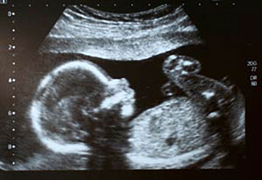 Ultrasounds